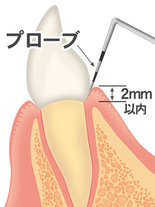 歯周病の進行：歯肉炎