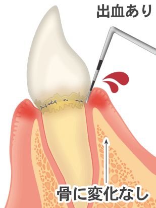歯周病の進行：軽度歯周炎