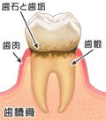 歯周病の原因：歯こう