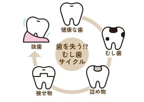 むし歯治療は歯の寿命を縮めます